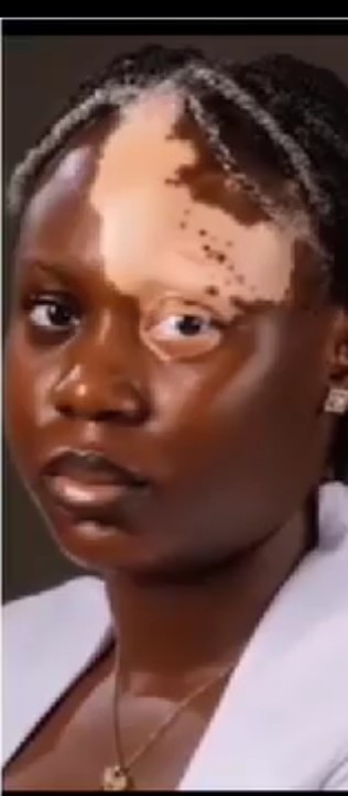 Lady Cries Out Over Stigmatisation Over Her Vitiligo Condition